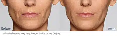 Restylane Define in New Jersey