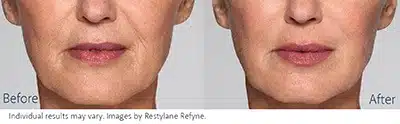 Restylane Refine in New Jersey