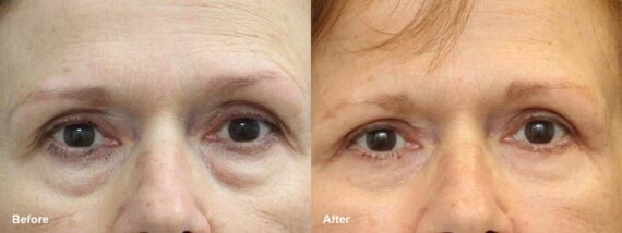 Lower Eyelid Surgery Before and After Photos in Princeton, NJ, Patient 7007