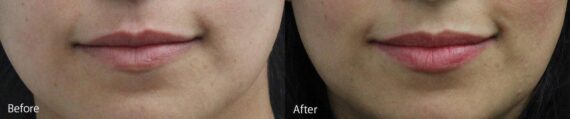 Lip Augmentation Before and After Photos in Princeton, NJ, Patient 7186