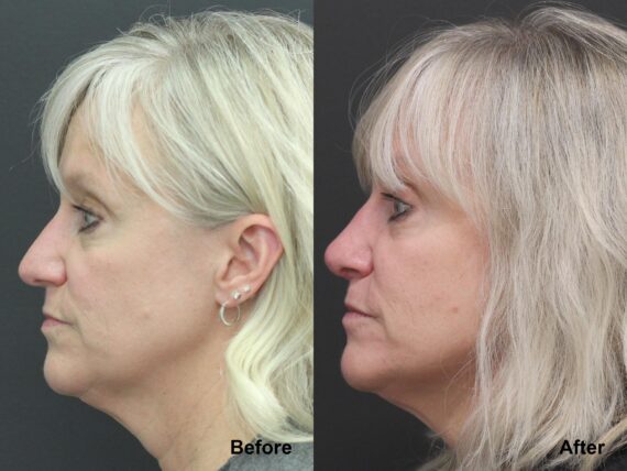 Rhinoplasty Before and After Photos in Princeton, NJ, Patient 7790