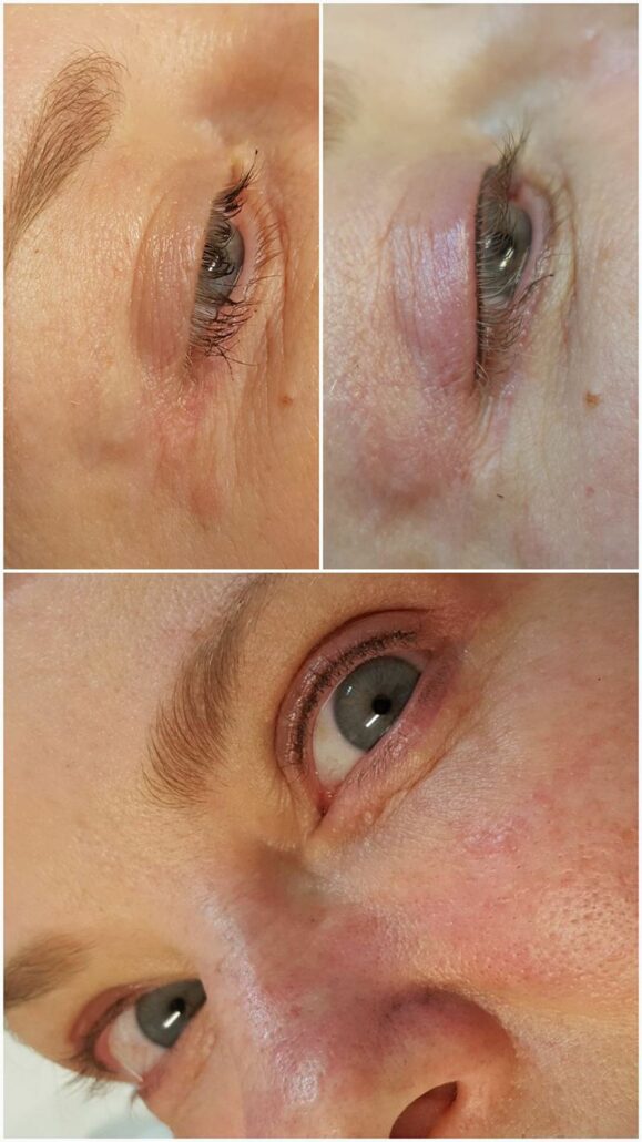 Microblading patient 4 before and after pictures