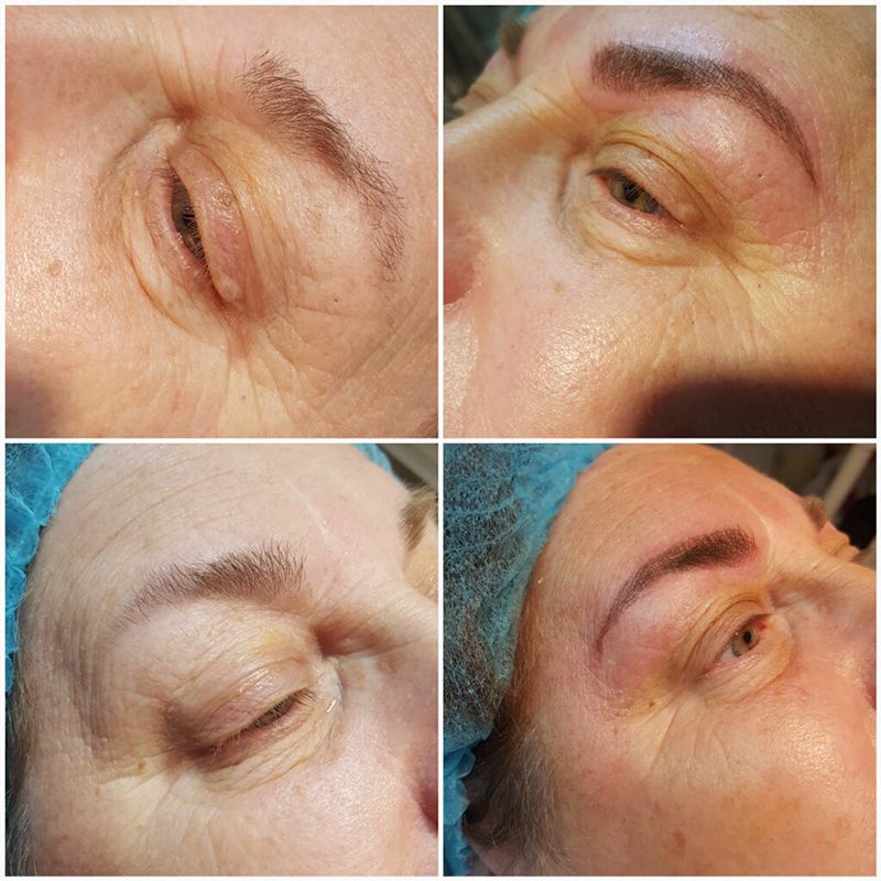 Microblading patient 2 before and after pictures