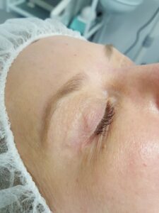 Microblading patient 1, picture of the before