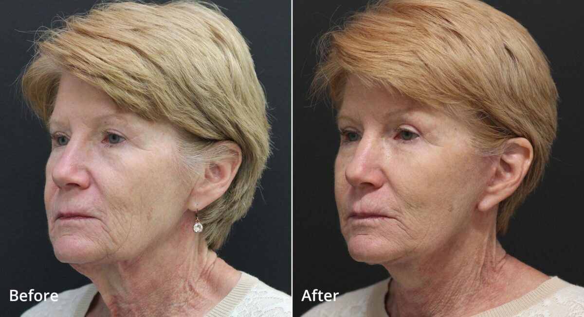 Neck Lift Before and After Photos in Princeton, NJ, Patient 8112