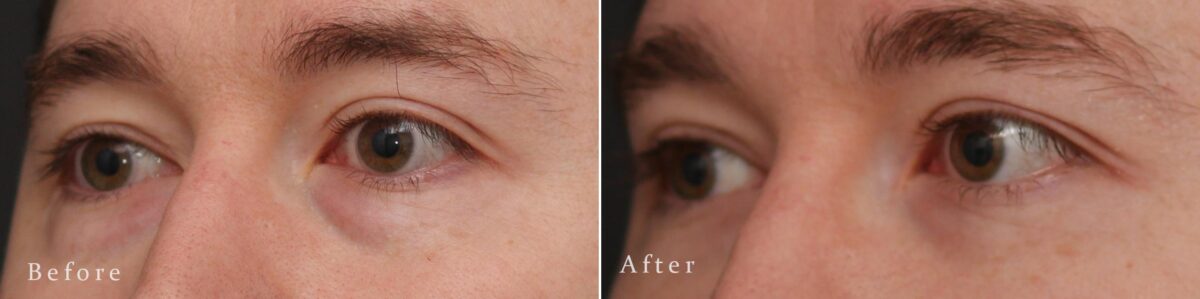 Lower Eyelid Surgery Before and After Photos in Princeton, NJ, Patient 8191