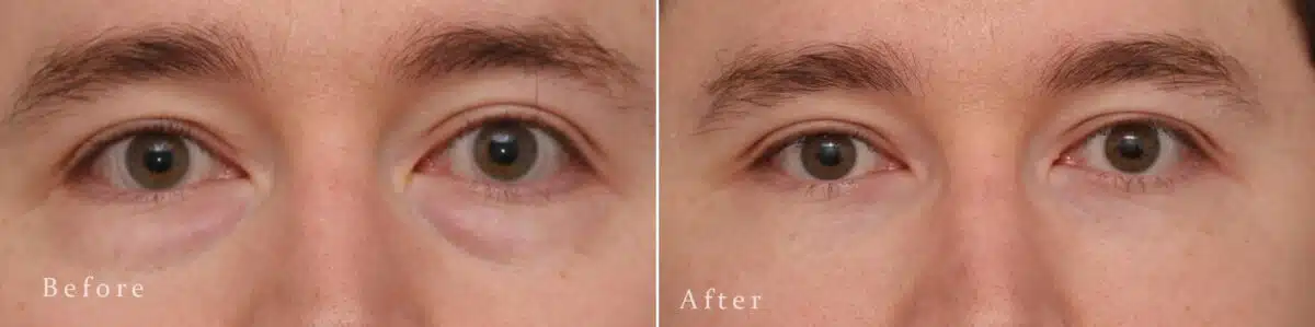 Lower Eyelid Surgery Before and After Photos in Princeton, NJ, Patient 8191