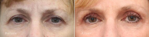 Upper Eyelid Surgery Before and After Photos in Princeton, NJ, Patient 8218