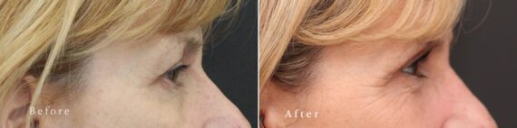 Upper Eyelid Surgery Before and After Photos in Princeton, NJ, Patient 8218