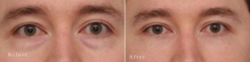 Lower Eyelid Surgery Before and After Photos in Princeton, NJ, Patient 8191
