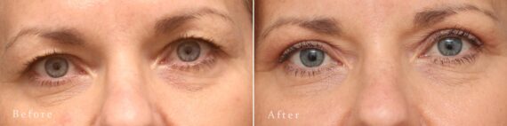 Upper Eyelid Surgery Before and After Photos in Princeton, NJ, Patient 8225