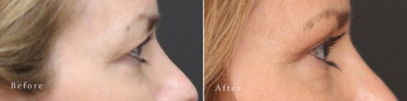 Upper Eyelid Surgery Before and After Photos in Princeton, NJ, Patient 8225