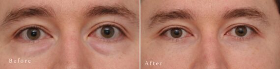 Lower Eyelid Surgery Before and After Photos in Princeton, NJ