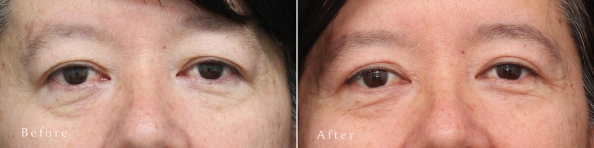 Upper Eyelid Surgery Before and After Photos in Princeton, NJ, Patient 8241