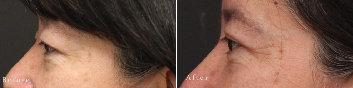 Upper Eyelid Surgery Before and After Photos in Princeton, NJ, Patient 8241