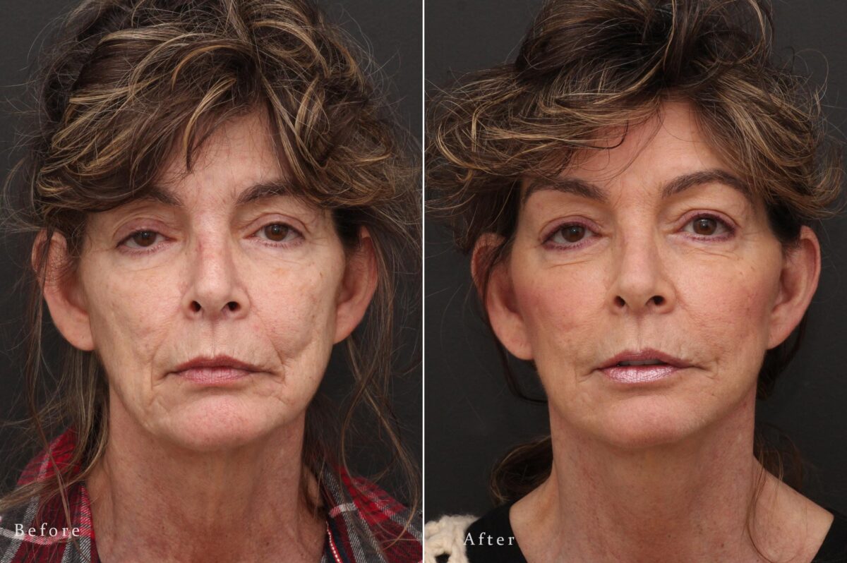 Facelift Before and After Photos in Princeton, NJ, Patient 8198