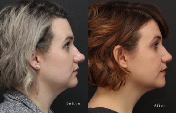 Rhinoplasty Before and After Photos in Princeton, NJ, Patient 8184