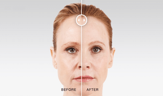 JUVÉDERM® XC dermal filler is a nonsurgical, physician-administered treatment for nasolabial folds and other facial wrinkles 