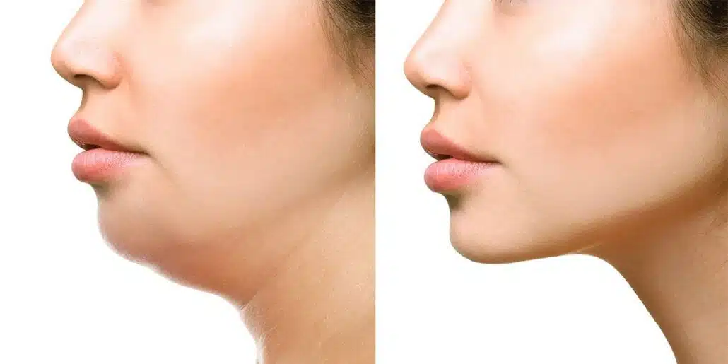 Kybella is a revolutionary treatment offered by Dr. Schrader as an  advanced, yet non-surgical method to address unwanted excess fat under  the chin 