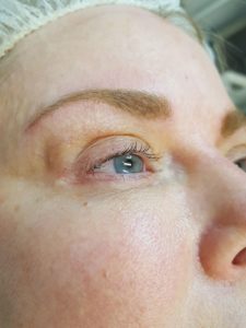 Microblading patient 1, picture of the after