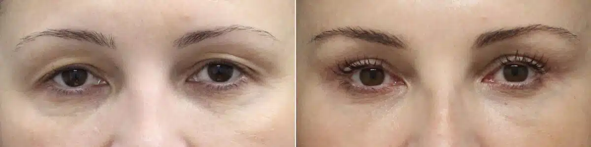 Upper Eyelid Surgery Before and After Photos in Princeton, NJ, Patient 8901