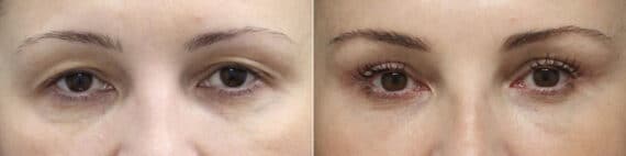 Upper Eyelid Surgery Before and After Photos in Princeton, NJ