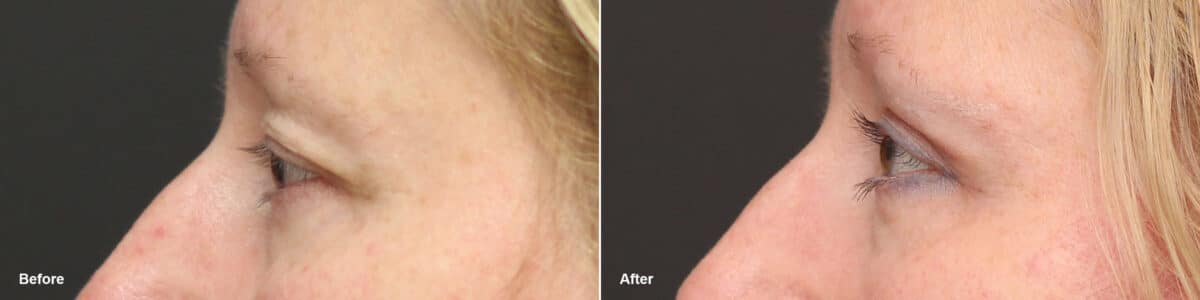 Upper Eyelid Surgery Before and After Photos in Princeton, NJ, Patient 9374