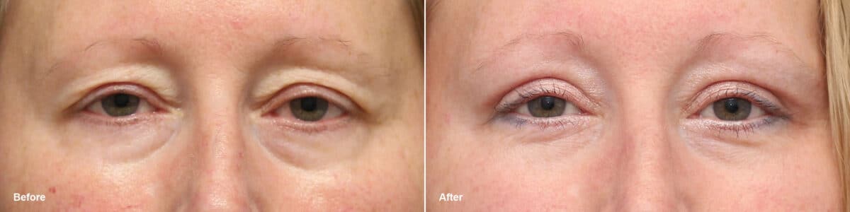 Upper Eyelid Surgery Before and After Photos in Princeton, NJ, Patient 9374