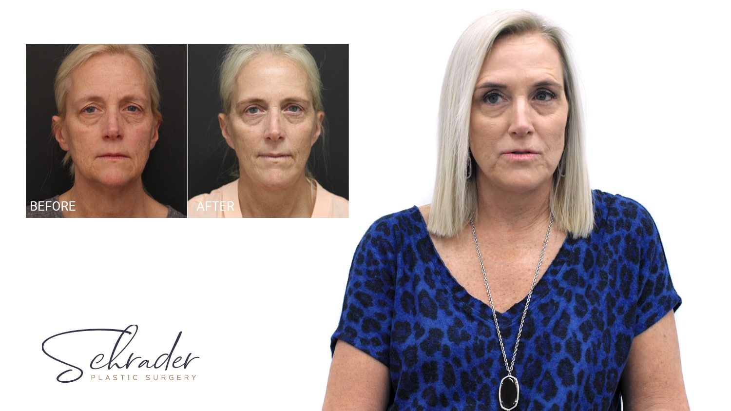 Facelift Patient