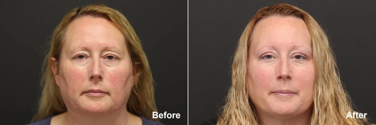 Laser Treatments Before and After Photos in Princeton, NJ, Patient 9353