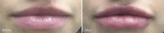 Lip Augmentation Before and After Photos in Princeton, NJ, Patient 9099