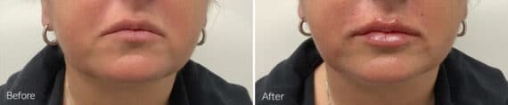 Lip Augmentation Before and After Photos in Princeton, NJ, Patient 9095