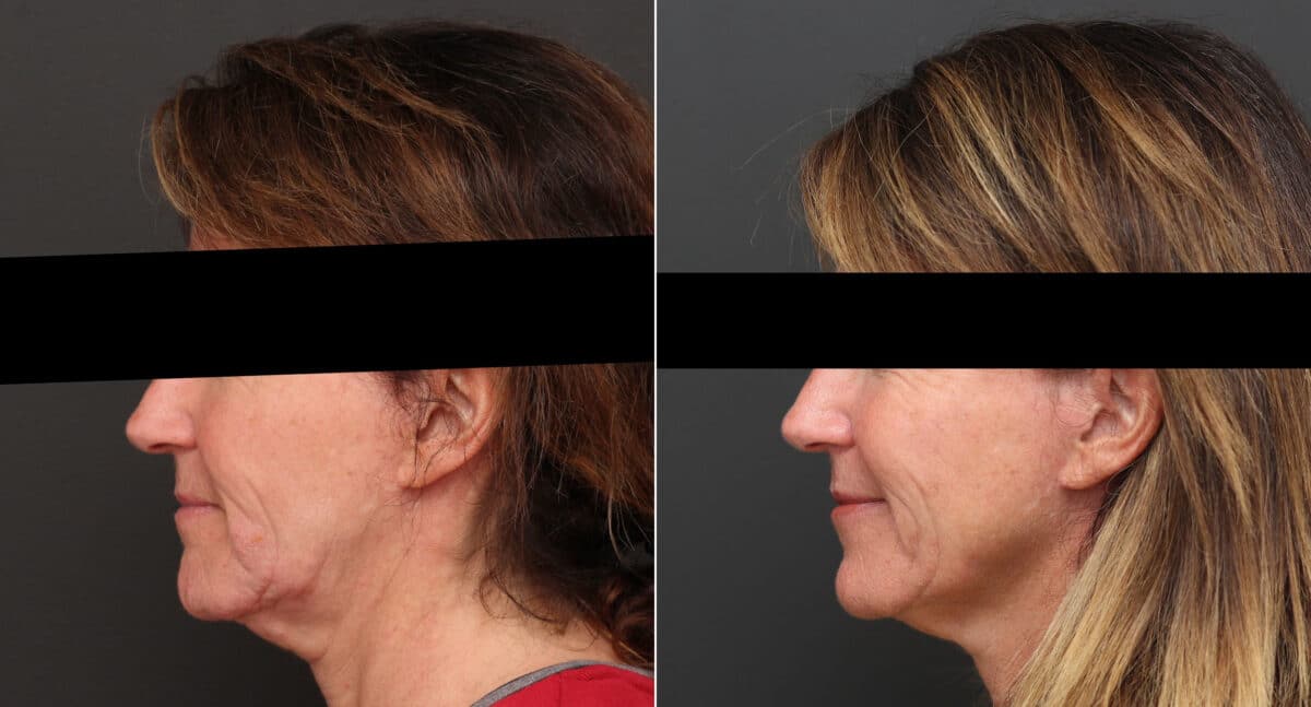 Instalift Before and After Photos in Princeton, NJ, Patient 9382