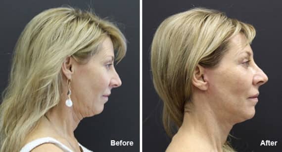 Facelift Before and After Photos in Princeton, NJ, Patient 7103