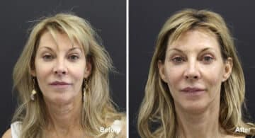 Facelift Before and After Photos in Princeton, NJ, Patient 7103