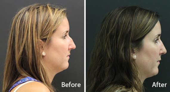Rhinoplasty Before and After Photos in Princeton, NJ, Patient 7265