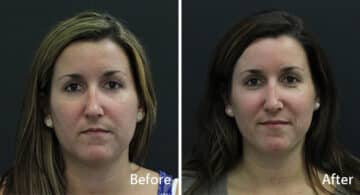 Rhinoplasty Before and After Photos in Princeton, NJ, Patient 7265