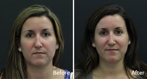 Rhinoplasty Before and After Photos in Princeton, NJ, Patient 7265