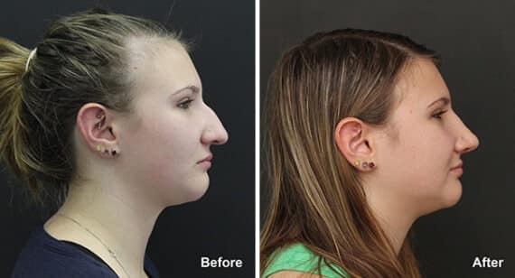 Rhinoplasty Before and After Photos in Princeton, NJ, Patient 7275