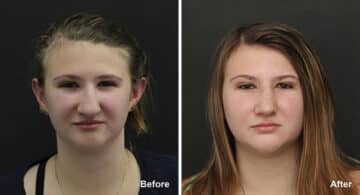 Rhinoplasty Before and After Photos in Princeton, NJ, Patient 7275