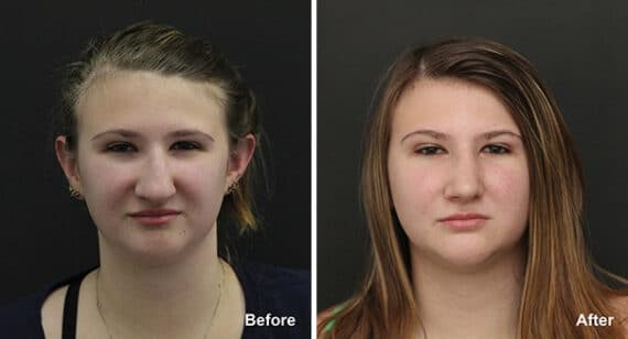 Rhinoplasty Before and After Photos in Princeton, NJ, Patient 7275