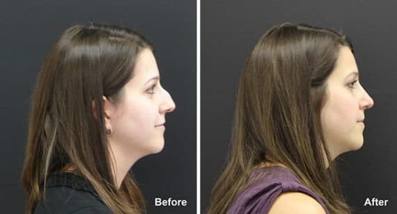 Rhinoplasty Before and After Photos in Princeton, NJ, Patient 7305