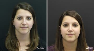 Rhinoplasty Before and After Photos in Princeton, NJ, Patient 7305
