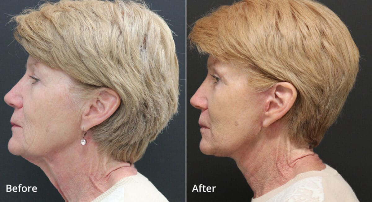 Neck Lift Before and After Photos in Princeton, NJ, Patient 8112