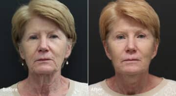 Neck Lift Before and After Photos in Princeton, NJ, Patient 8112