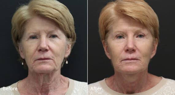 Neck Lift Before and After Photos in Princeton, NJ, Patient 8112