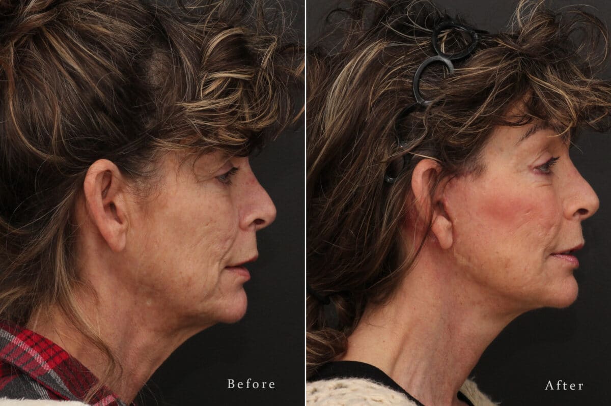 Facelift Before and After Photos in Princeton, NJ, Patient 8198