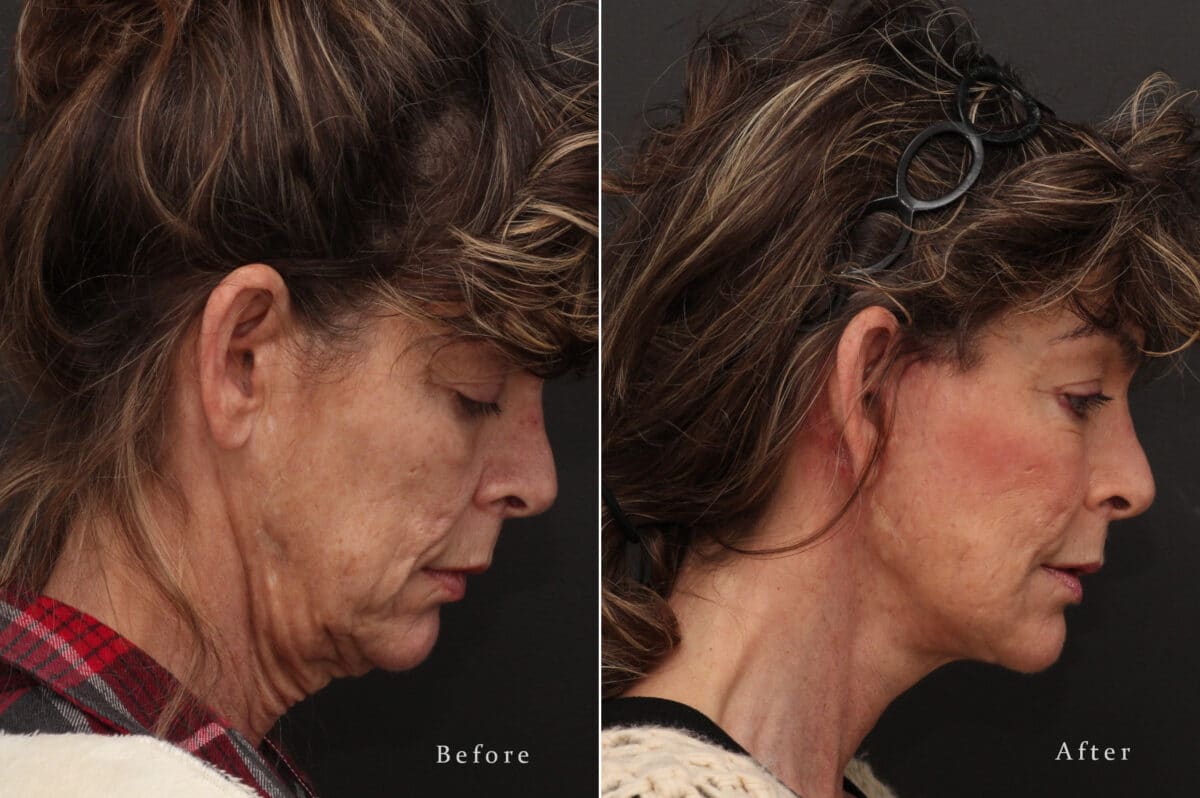 Facelift Before and After Photos in Princeton, NJ, Patient 8198