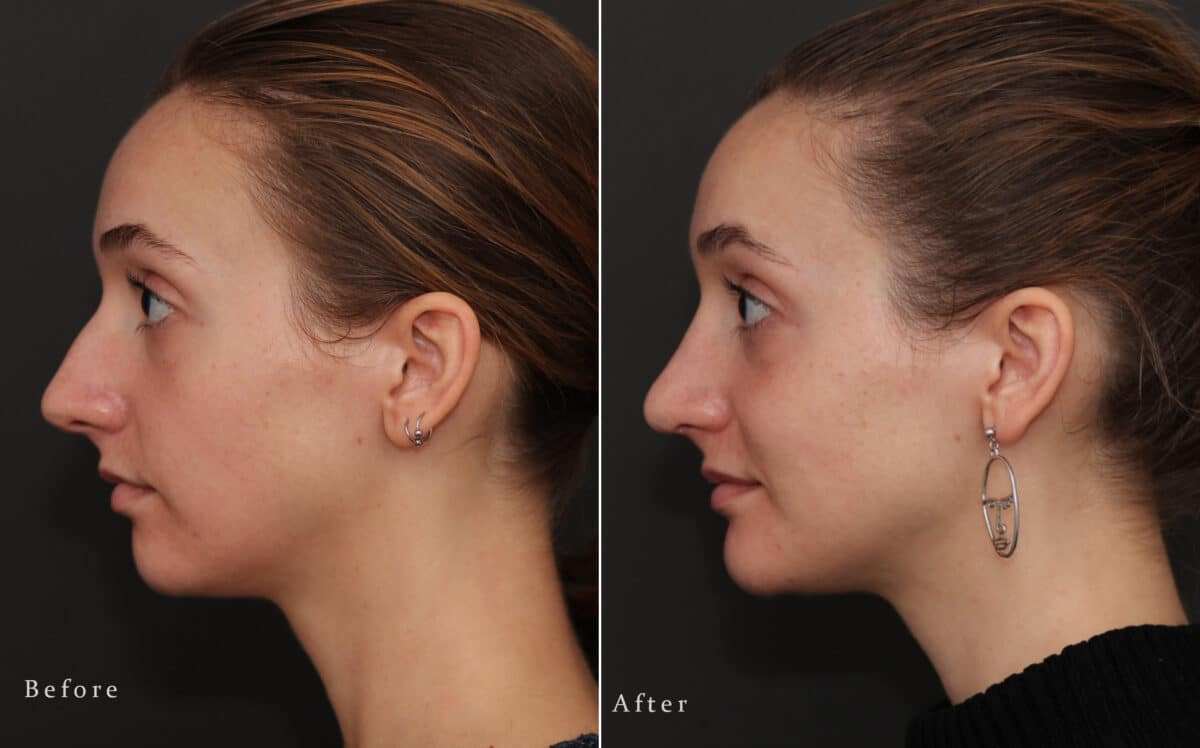 Rhinoplasty Before and After Photos in Princeton, NJ, Patient 8249