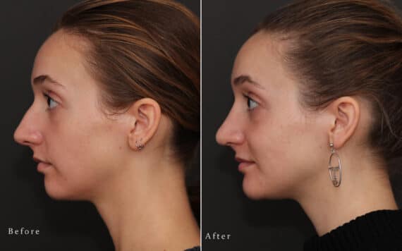 Rhinoplasty Before and After Photos in Princeton, NJ, Patient 8249